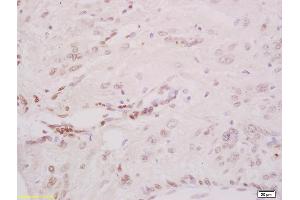 Formalin-fixed and paraffin embedded human cervical carcinoma labeled with Anti-Phospho-CHK2 (Thr68) Polyclonal Antibody, Unconjugated (ABIN703165) at 1:200 followed by conjugation to the secondary antibody and DAB staining
