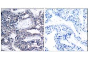 Immunohistochemical analysis of paraffin- embedded human breast carcinoma tissue using MEK2 (phospho-Thr394) antibody (E011008). (MEK2 Antikörper  (pThr394))
