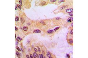Immunohistochemical analysis of Cathepsin D staining in human liver cancer formalin fixed paraffin embedded tissue section. (Cathepsin D Antikörper  (Center))