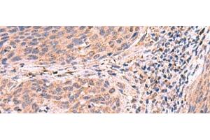 Immunohistochemistry of paraffin-embedded Human cervical cancer tissue using PER3 Polyclonal Antibody at dilution of 1:55(x200) (PER3 Antikörper)