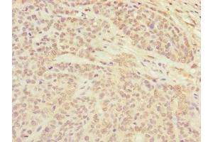Immunohistochemistry of paraffin-embedded human ovarian cancer using ABIN7147357 at dilution of 1:100