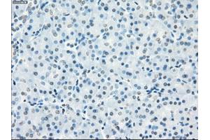 Immunohistochemical staining of paraffin-embedded Adenocarcinoma of breast tissue using anti-FCGR2A mouse monoclonal antibody. (FCGR2A Antikörper)