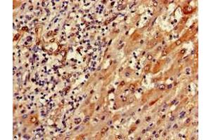 Immunohistochemistry of paraffin-embedded human liver cancer using ABIN7168819 at dilution of 1:100