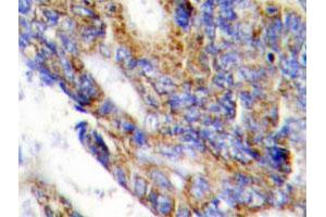 Immunohistochemical analysis of paraffin-embedded human colon cancer tissue using COL1A2 polyclonal antibody . (COL1A2 Antikörper)