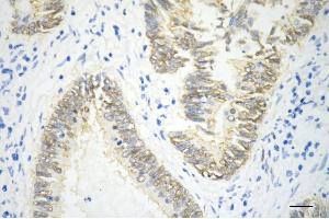 Immunohistochemistry was performed on paraffin-embedded human sigmoid colon carcinoma using catenin beta 1 antibody (ABIN7797925), 1:200).