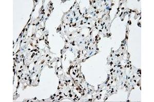 Immunohistochemical staining of paraffin-embedded Adenocarcinoma of ovary tissue using anti-DAPK2 mouse monoclonal antibody. (DAPK2 Antikörper)