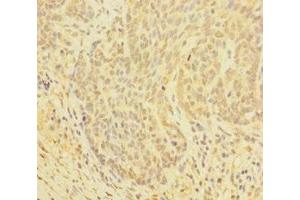 Immunohistochemistry of paraffin-embedded human ovarian cancer using ABIN7154046 at dilution of 1:100 (Glutaredoxin 1 Antikörper  (AA 1-106))