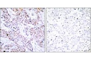 Immunohistochemistry analysis of paraffin-embedded human breast carcinoma tissue, using Estrogen Receptor-alpha (Ab-106) Antibody. (Estrogen Receptor alpha Antikörper  (AA 71-120))
