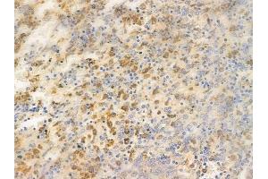 ABIN6255877 and ABIN6267450 at 1/100 staining human melanoma by IHC-P.