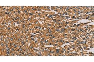 Immunohistochemistry of paraffin-embedded Human lung cancer tissue using PARP11 Polyclonal Antibody at dilution 1:30 (PARP11 Antikörper)
