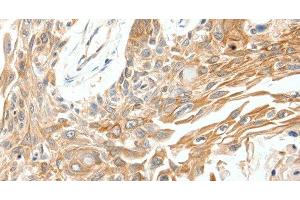 Immunohistochemistry of paraffin-embedded Human breast cancer tissue using SCN11A Polyclonal Antibody at dilution 1:40