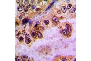 Immunohistochemical analysis of GABRD staining in human lung cancer formalin fixed paraffin embedded tissue section. (GABRD Antikörper)