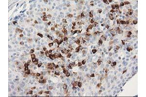 Immunohistochemical staining of paraffin-embedded Adenocarcinoma of Human breast tissue using anti-MGLL mouse monoclonal antibody. (MGLL Antikörper)