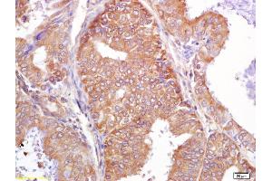 Formalin-fixed and paraffin embedded human breast carcinoma labeled with Rabbit Anti PALB2 Polyclonal Antibody, Unconjugated (ABIN670536) at 1:200 followed by conjugation to the secondary antibody and DAB staining (PALB2 Antikörper  (AA 1101-1186))