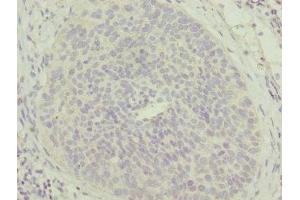 Immunohistochemistry of paraffin-embedded human cervical cancer using ABIN7159869 at dilution of 1:100