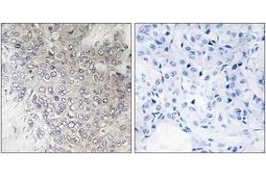 Immunohistochemistry analysis of paraffin-embedded human breast carcinoma, using p70 S6 Kinase (Phospho-Thr421) Antibody. (RPS6KB1 Antikörper  (pThr444))