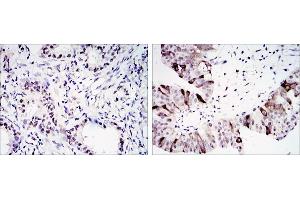 Immunohistochemical analysis of paraffin-embedded lung cancer (left) and ovary tumour tissues (right) using CCNB1 antibody with DAB staining. (Cyclin B1 Antikörper)