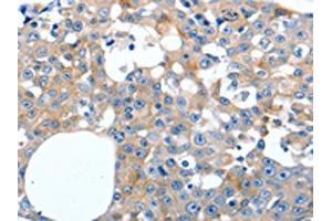 The image on the left is immunohistochemistry of paraffin-embedded Human breast cancer tissue using ABIN7191279(LILRB3 Antibody) at dilution 1/20, on the right is treated with synthetic peptide. (LILRB3 Antikörper)