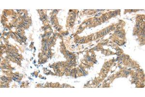 Immunohistochemistry of paraffin-embedded Human colon cancer tissue using KCNG3 Polyclonal Antibody at dilution 1:40 (KCNG3 Antikörper)