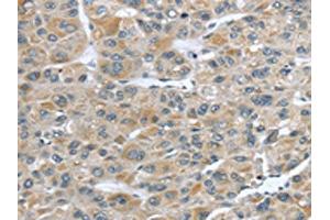The image on the left is immunohistochemistry of paraffin-embedded Human liver cancer tissue using ABIN7190228(CFAP45 Antibody) at dilution 1/25, on the right is treated with synthetic peptide. (CCDC19 Antikörper)