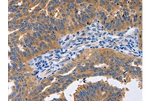 The image on the left is immunohistochemistry of paraffin-embedded Human ovarian cancer tissue using ABIN7191576(NBEA Antibody) at dilution 1/60, on the right is treated with synthetic peptide. (Neurobeachin Antikörper)