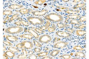 ABIN6261360 and ABIN6273231 at 1/100 staining Human kidney cancer and adjacent normal tissues by IHC-P. (DPP4 Antikörper  (C-Term))