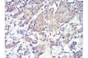Immunohistochemical analysis of paraffin-embedded breast cancer tissues using PLCG1 mouse mAb with DAB staining. (Phospholipase C gamma 1 Antikörper  (AA 1192-1291))