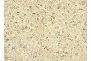 Immunohistochemistry of paraffin-embedded human glioma using ABIN7158190 at dilution of 1:100 (LRRC4C Antikörper  (AA 201-500))
