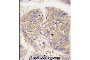 Formalin-fixed and paraffin-embedded human hepatocarcinoma tissue reacted with Dtnbp1 Antibody (N-term) (ABIN389169 and ABIN2839335) , which was peroxidase-conjugated to the secondary antibody, followed by DAB staining. (DTNBP1 Antikörper  (N-Term))