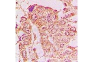 Immunohistochemical analysis of GRASP65 staining in human breast cancer formalin fixed paraffin embedded tissue section. (GORASP1 Antikörper)