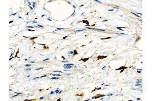 ABIN6261701 and ABIN6276667 at 1/100 staining Human ovarian cancer and adjacent normal tissues by IHC-P.