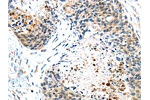 The image on the left is immunohistochemistry of paraffin-embedded Human esophagus cancer tissue using ABIN7131404(TMPRSS4 Antibody) at dilution 1/45, on the right is treated with fusion protein. (TMPRSS4 Antikörper)