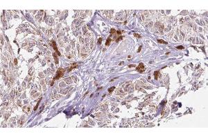 ABIN6275666 at 1/100 staining Human Melanoma tissue by IHC-P. (UEVLD Antikörper  (N-Term))