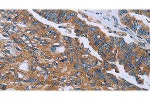 Immunohistochemistry of paraffin-embedded Human ovarian cancer using GAB2 Polyclonal Antibody at dilution of 1:40 (GAB2 Antikörper)