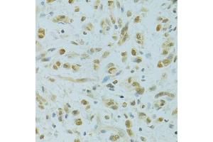Immunohistochemistry of paraffin-embedded human gastric cancer using RCC1 antibody (ABIN5973761) at dilution of 1/100 (40x lens). (RCC1 Antikörper)