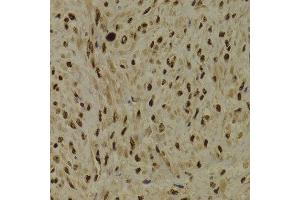 Immunohistochemistry of paraffin-embedded Human adenomyosis using PPP1R8 antibody at dilution of 1:100 (x400 lens). (PPP1R8 Antikörper)