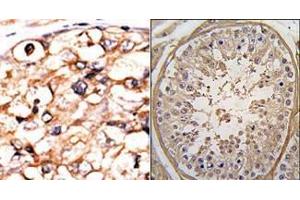 (LEFT)Formalin-fixed and paraffin-embedded human cancer tissue reacted with the primary antibody, which was peroxidase-conjugated to the secondary antibody, followed by AEC staining. (PGK2 Antikörper  (N-Term))