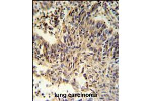 RXRA Antibody IHC analysis in formalin fixed and paraffin embedded lung carcinoma followed by peroxidase conjugation of the secondary antibody and DAB staining. (Retinoid X Receptor alpha Antikörper  (AA 196-224))