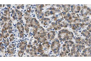 ABIN6268790 at 1/100 staining Human liver cancer tissue by IHC-P. (FSHR Antikörper  (Internal Region))