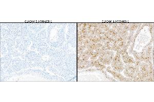 Immunohistochemistry (IHC) image for anti-Carcinoembryonic Antigen-Related Cell Adhesion Molecule 5 (CEACAM5) (AA 35-685) antibody (ABIN7453964) (Rekombinanter CEACAM5 Antikörper  (AA 35-685))