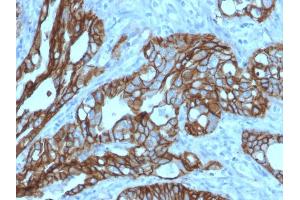 Formalin-fixed, paraffin-embedded human Colon Carcinoma stained with TACSTD2 / TROP2 Mouse Monoclonal Antibody (TACSTD2/2152). (TACSTD2 Antikörper  (AA 31-274))