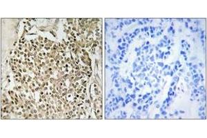 Immunohistochemistry analysis of paraffin-embedded human breast carcinoma, using CEP350 Antibody. (CEP350 Antikörper  (AA 671-720))