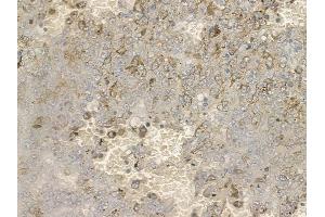ABIN6255527 and ABIN6267173 at 1/100 staining human melanoma by IHC-P.