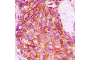 Immunohistochemical analysis of GPR159 staining in human breast cancer formalin fixed paraffin embedded tissue section. (CXCR7 Antikörper  (C-Term))