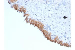 Formalin-fixed, paraffin-embedded human Bladder Carcinoma stained with MAML2 Monoclonal Antibody (MAML2/1302). (MAML2 Antikörper)