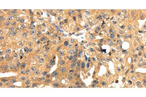 Immunohistochemistry of paraffin-embedded Human breast cancer tissue using SH3KBP1 Polyclonal Antibody at dilution 1:45 (SH3KBP1 Antikörper)