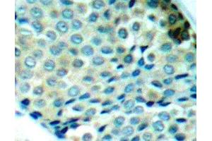 Immunohistochemistry of paraffin-embedded Human breast carcinoma using Phospho-HSPB1(S78) Polyclonal Antibody (HSP27 Antikörper  (pSer78))