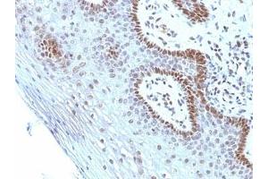 Formalin-fixed, paraffin-embedded human cervical carcinoma stained with Myc antibody (SPM237).