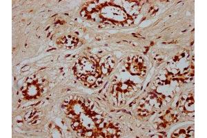 IHC image of ABIN7166751 diluted at 1:300 and staining in paraffin-embedded human breast cancer performed on a Leica BondTM system.