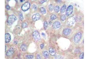 Immunohistochemistry analyzes of p70 S6K antibody in paraffin-embedded human breast carcinoma tissue. (RPS6KB1 Antikörper)